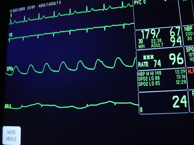 Electro Cardiogram